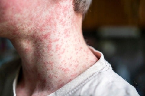 Person's neck and face covered in a measles rash