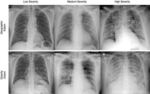 Chest x-rays of COVID-19 patients showing the extend and opacity of infections.