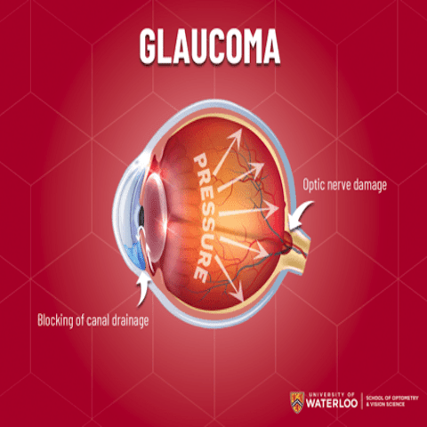 Graphic of inner eye showing glaucoma