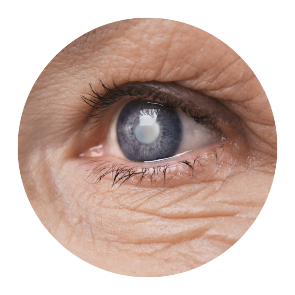 closeup of older woman's eye with cloudy pupil