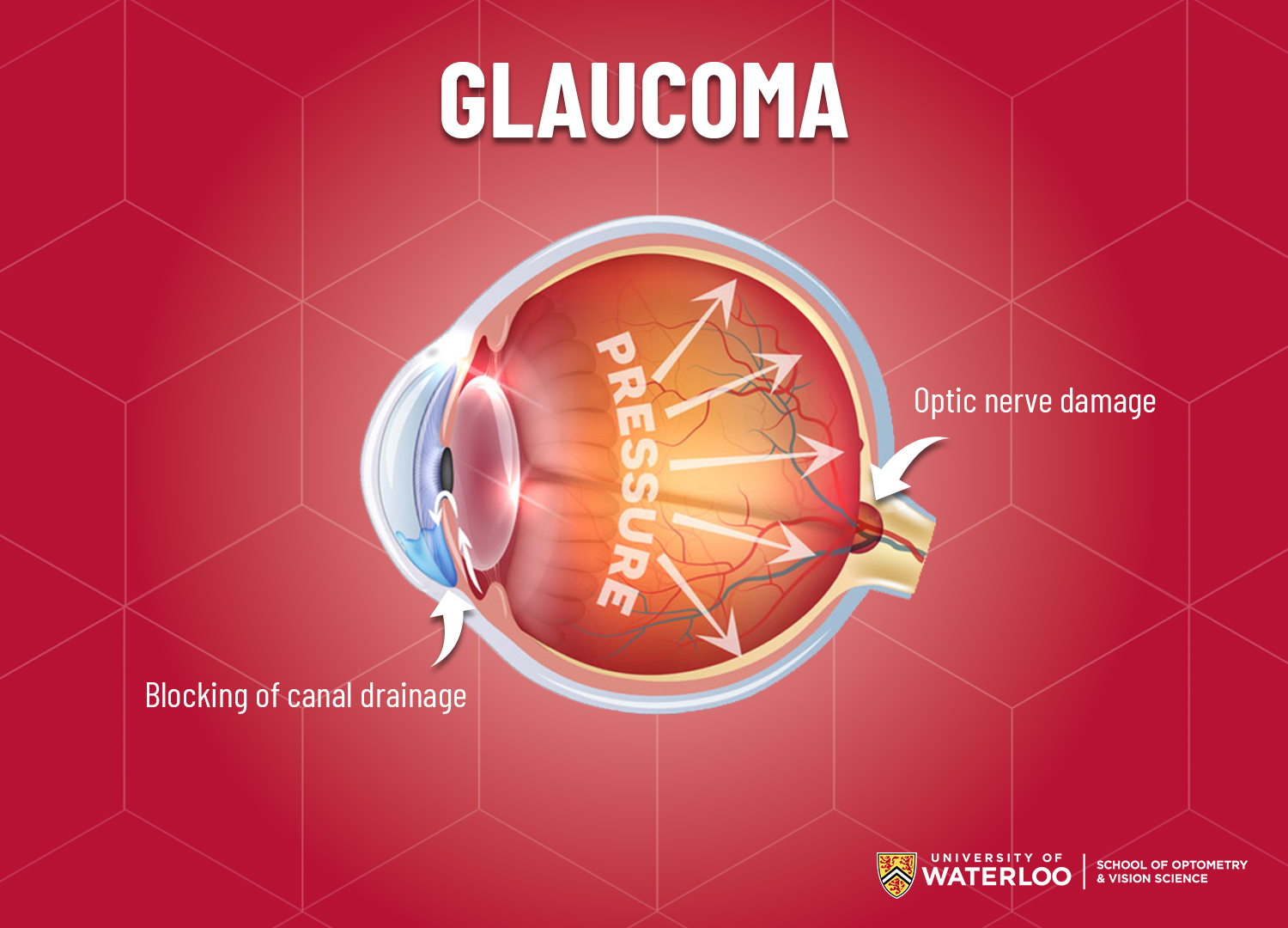 Graphic of eye showing glaucoma damage