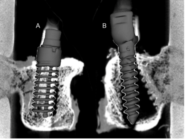 bone implant drilling