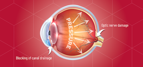 Cross section of the eye highlighting the changes from glaucoma.