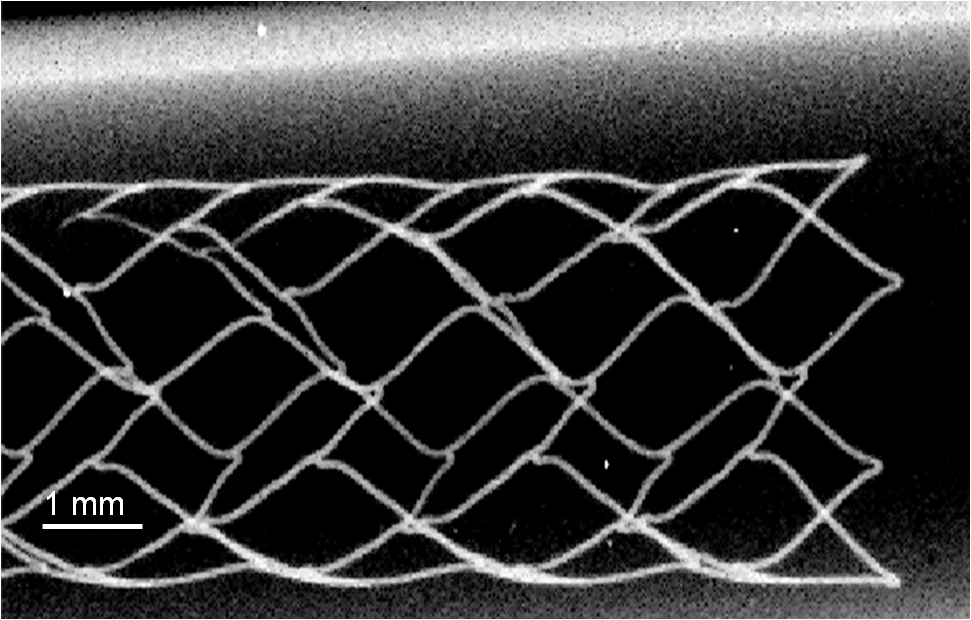 An x-ray image of an aorta stent with 25-50 micron thick wires