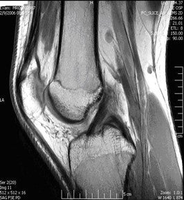 Figure: The ACL, cadaveric and MRI view.