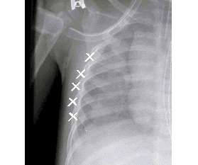 X-ray of the left side ribs of a child with `best match`points marked by `x`determined by optimal algorithm