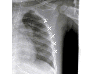 X-ray image of a child`s right side ribs with `x`s marking control points