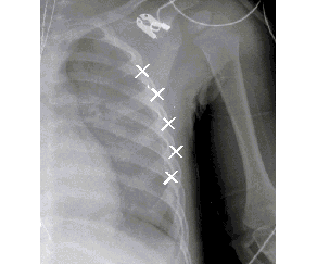 X-ray image of a child`s right side ribs with `best match`points determined by optimal algorithm