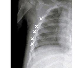 x-ray of a child left side of ribs with `x`marking control points