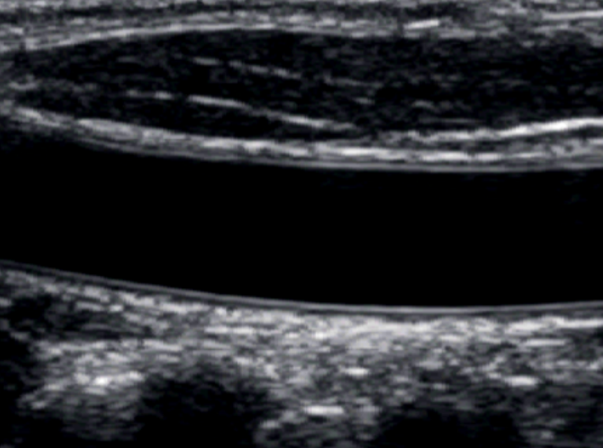 B-mode image of the common carotid artery with clear arterial walls