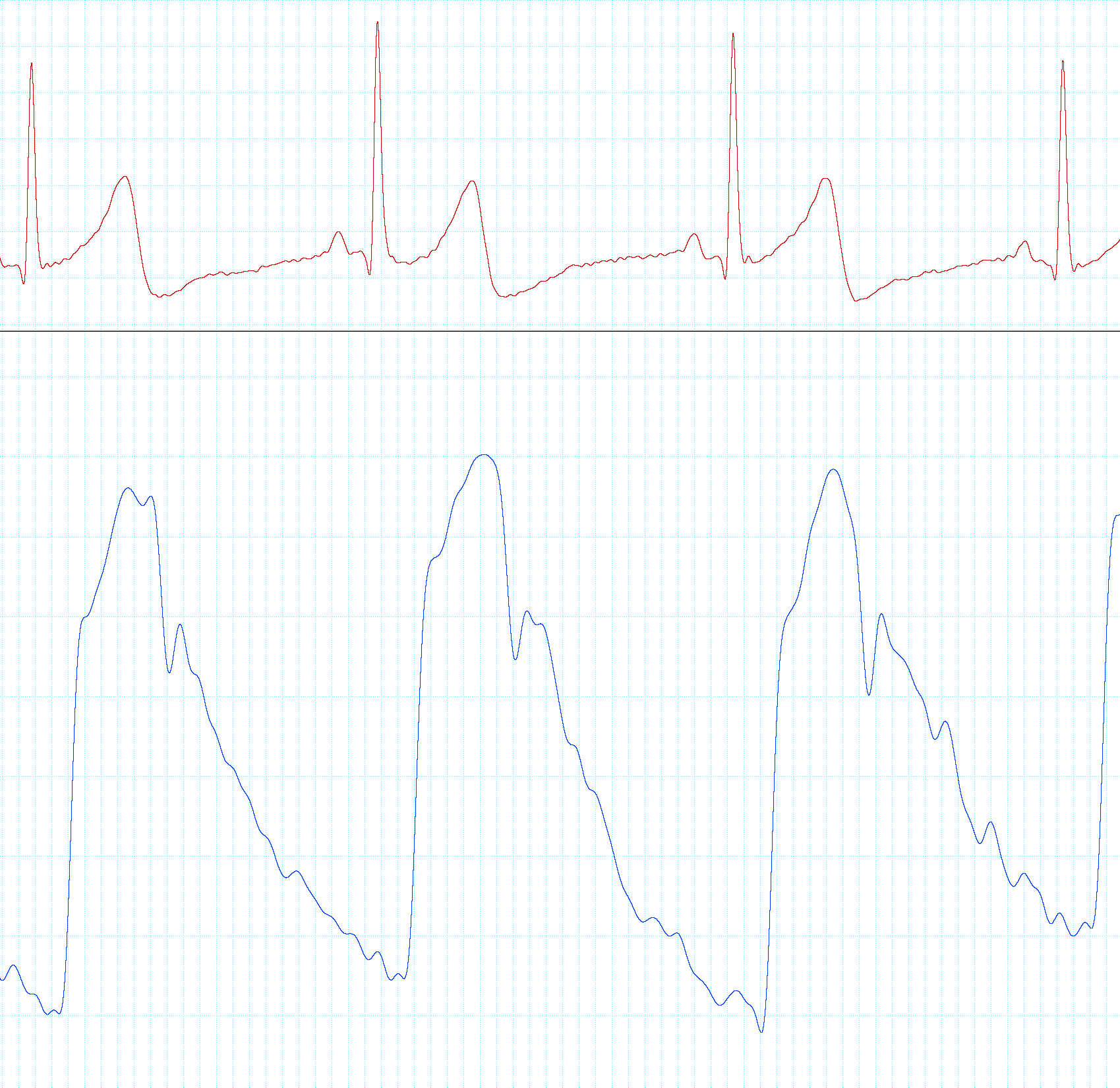 Electrocardiogram and tonometry waveforms