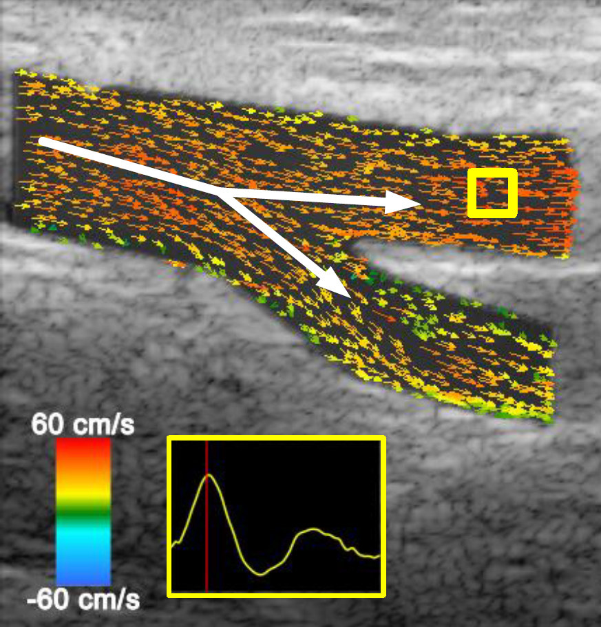 Vector projectile imaging of blood moving through the femoral bifurcation