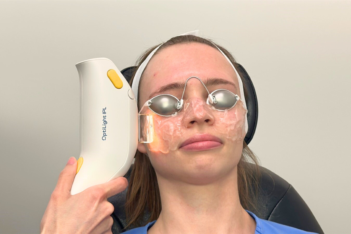 Dr. Ivana Latalisa doing IPL on Yulia Skobkareva